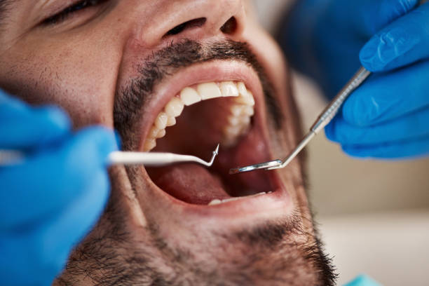 Best Emergency Tooth Extraction in Albany, WI